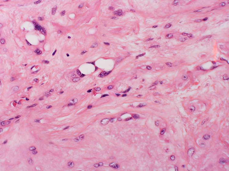 Epithelioid Hemangioendothelioma Ehe