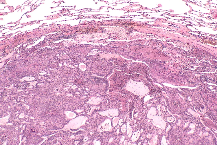 Pulmonary Mixed Squamous Cell And Glandular Papilloma Dovemed