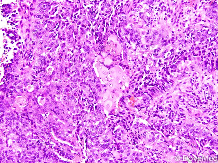 Adenosquamous Carcinoma Of Vagina