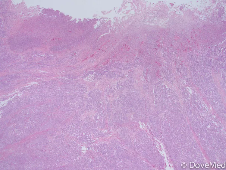 Medullary Carcinoma Of Colon And Rectum Dovemed