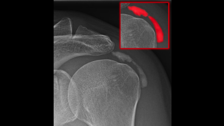 Shoulder Bursitis Picture