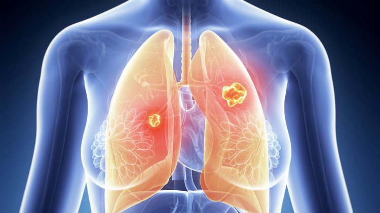 Benign And Malignant Tumors Of The Lung