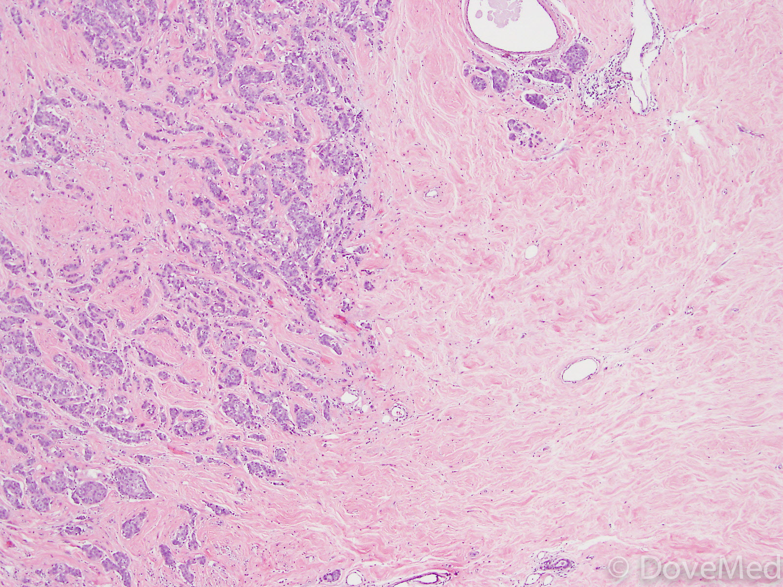 Invasive anal carcinoma