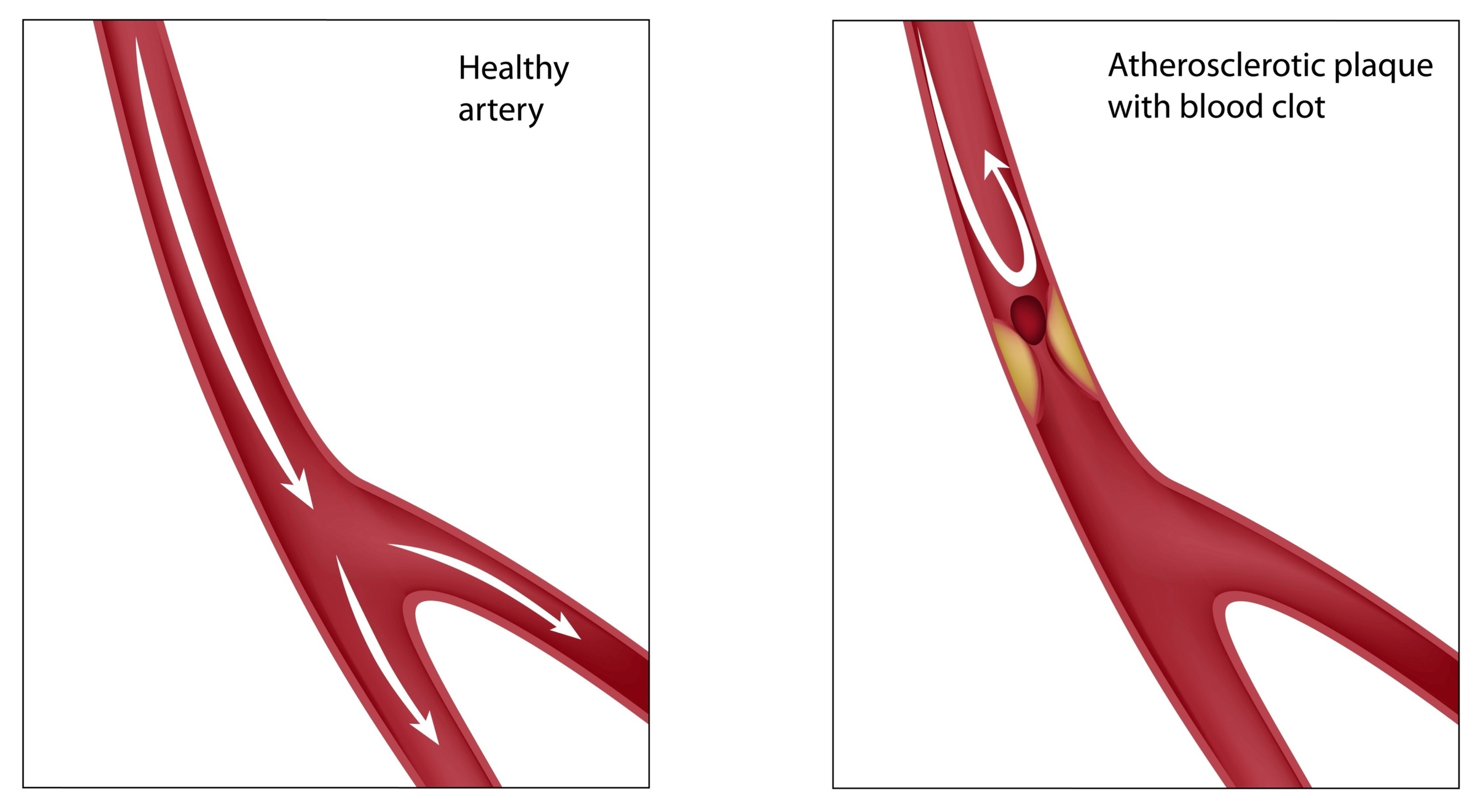 hardening-of-the-arteries