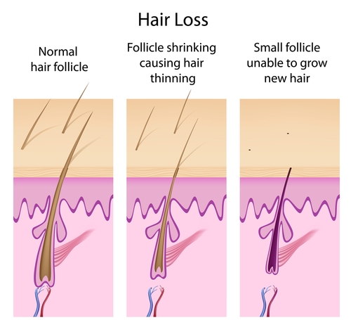 what-does-hair-loss-have-to-teach-us-about-cancer-metastasis