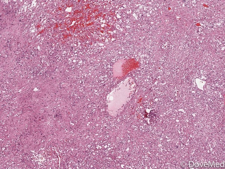 angiomyolipoma-of-kidney