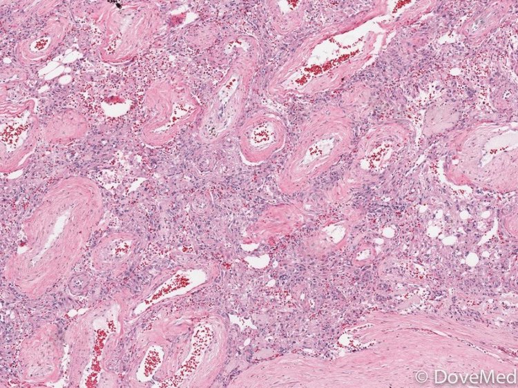 Angiomyolipoma of Testis