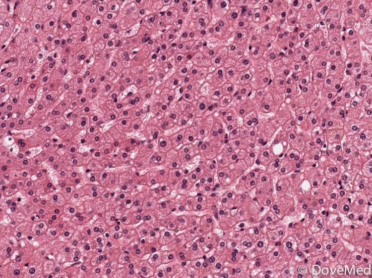 Angiomyolipoma of Parotid Gland - DoveMed