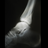 X-ray showing a Stress Fracture of the Ankle.