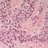 Microscopic pathology image showing Ependymoma. H&E stained paraffin section (WHO Grade II).