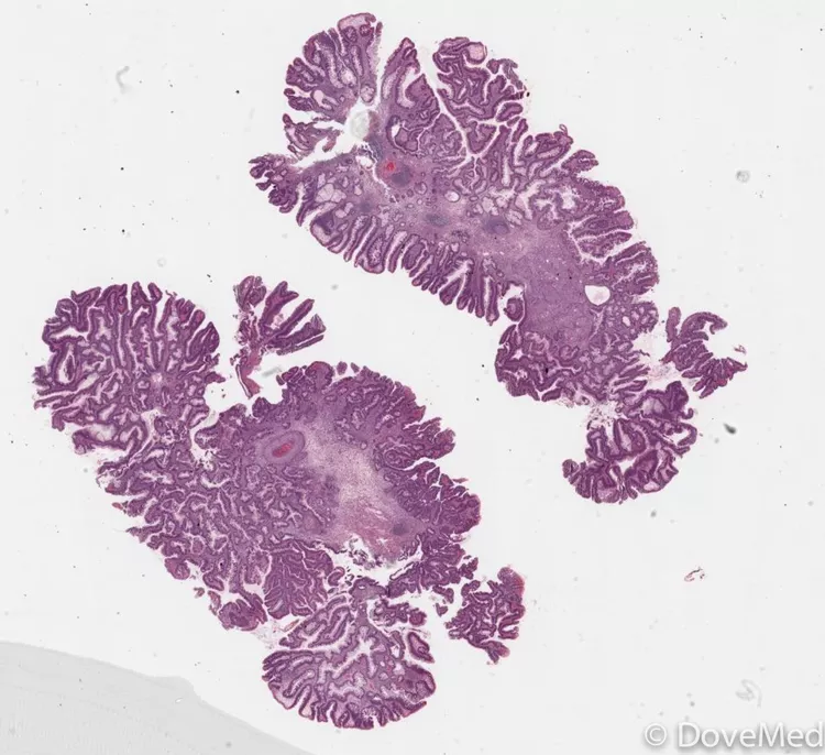 Adenosquamous Carcinoma Of Colon And Rectum Dovemed