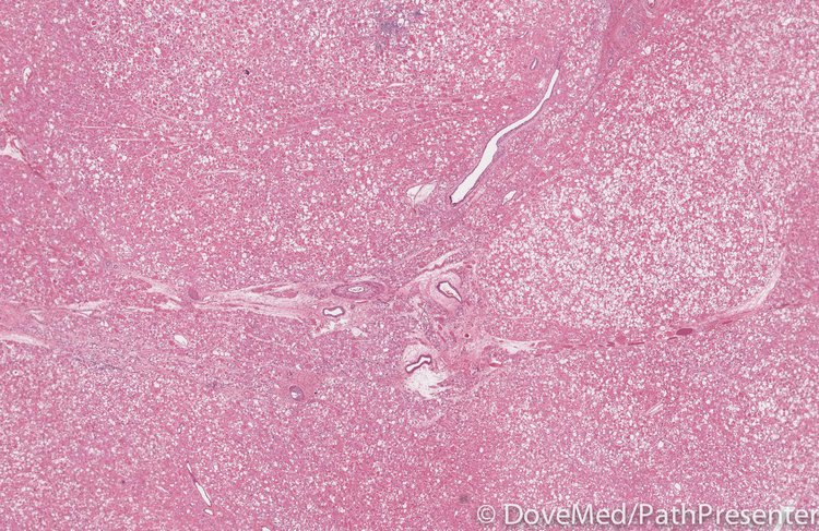 Adult Rhabdomyoma