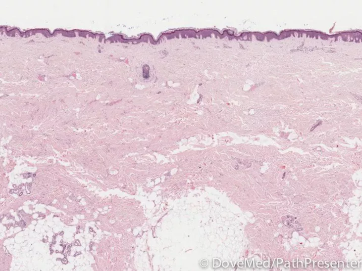 Palmar Fibromatosis - DoveMed