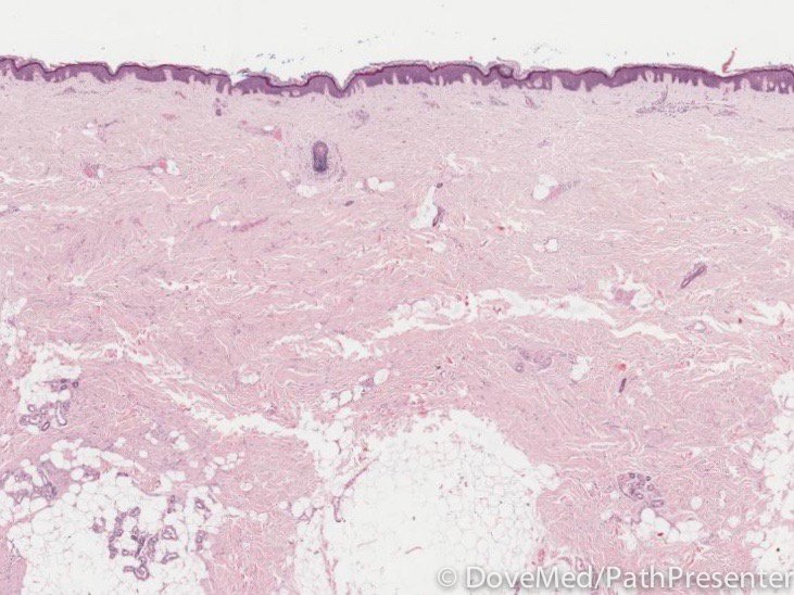 Palmar Fibromatosis