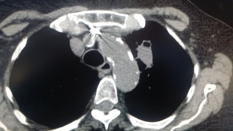 Small Cell Lung Cancer