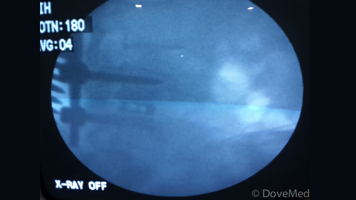 Transforaminal Lumbar Interbody Fusion