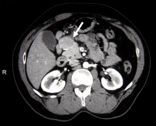 Castleman Disease (CD)