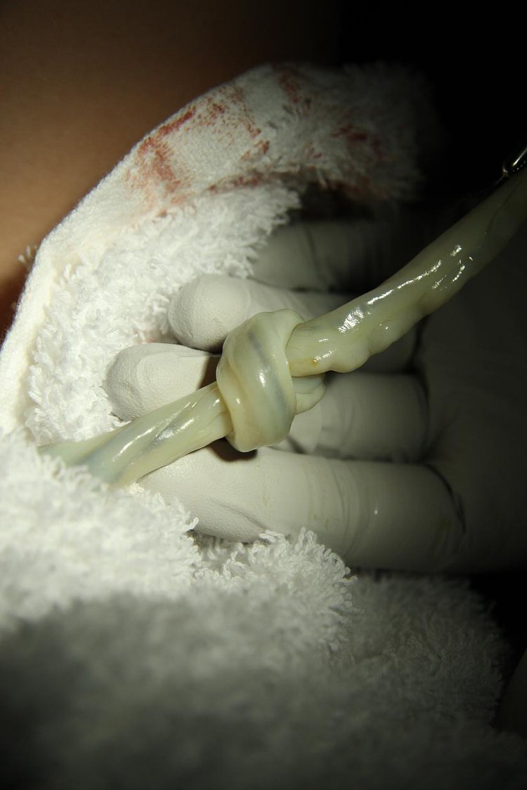 Wait A Minute! Clamping The Umbilical Cord Later Saves Preterm Babies' Lives