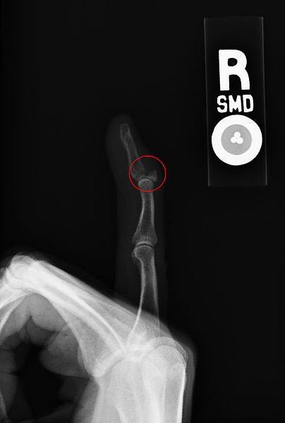 xray of broken finger