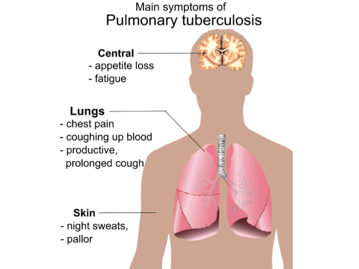 Pulmonary Tuberculosis