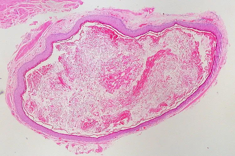 Epidermal Inclusion Cyst - DoveMed