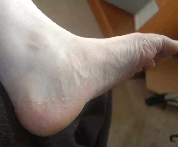 Athlete's foot - Tinea pedis - DocCheck