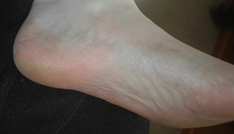 heel athlete's foot