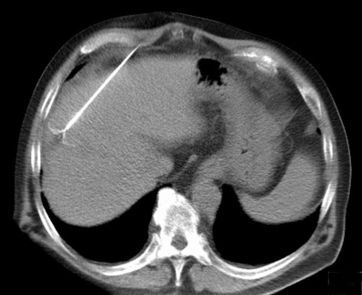 Radiofrequency Ablation Of Liver Tumor 0229