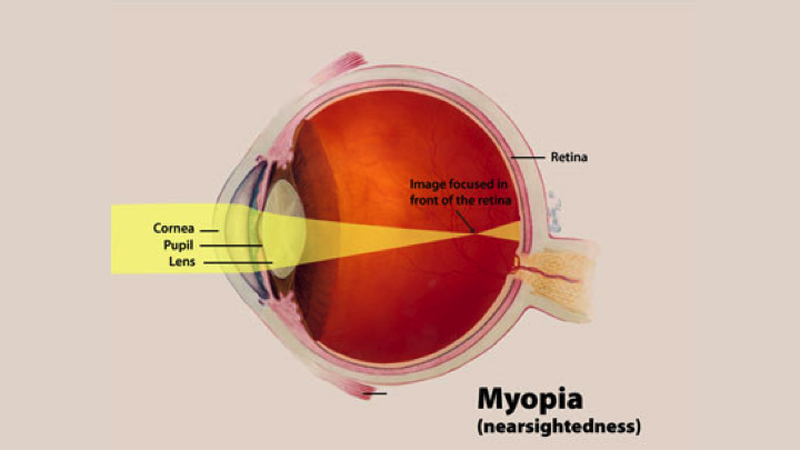 nearsightedness