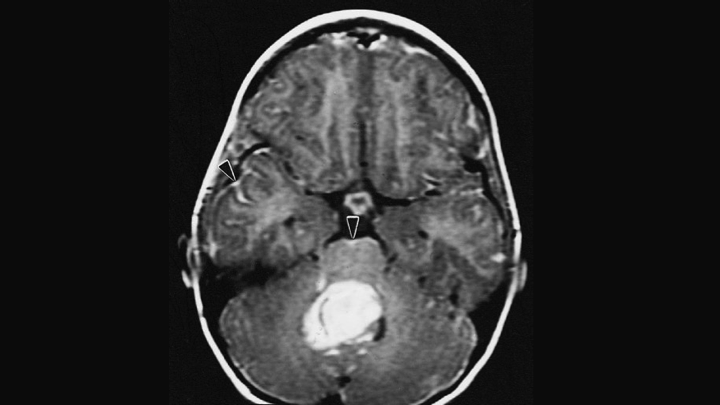 qarc medulloblastoma qarc medulloblastoma