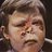 An image of a young girl suffering from congenital Syphilis to the face.