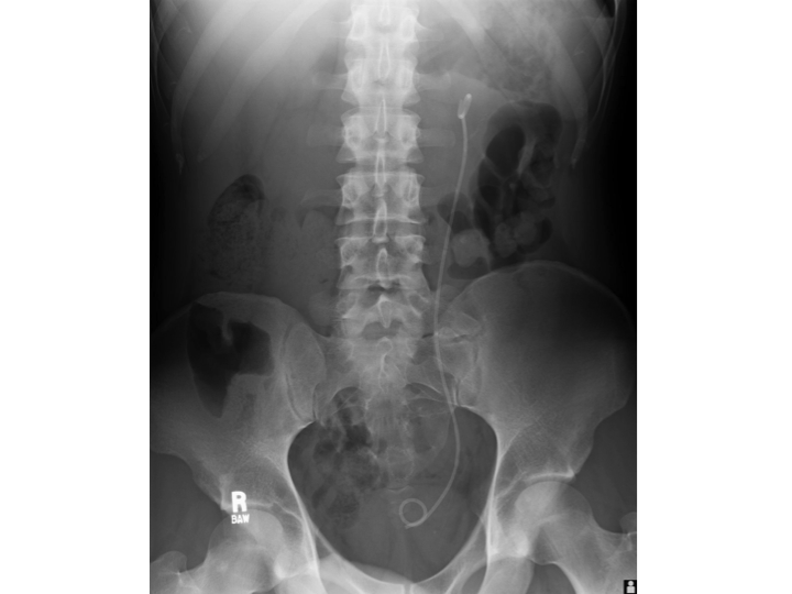 Ureteral Stenting and Nephrostomy