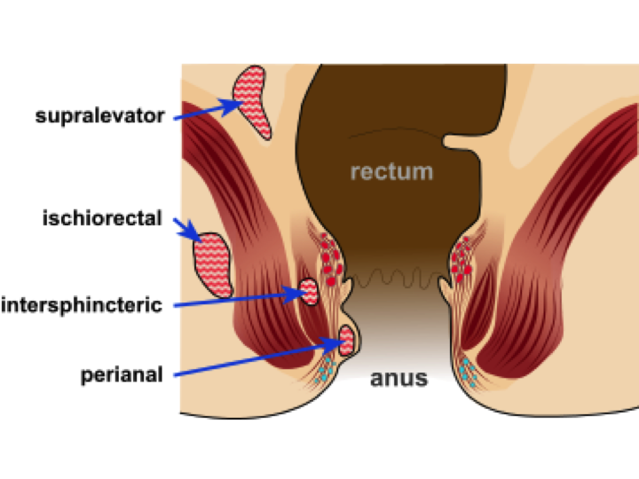 Anorectal Abscess-6029