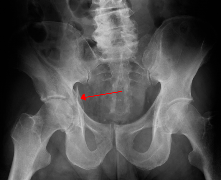 pelvic-fracture