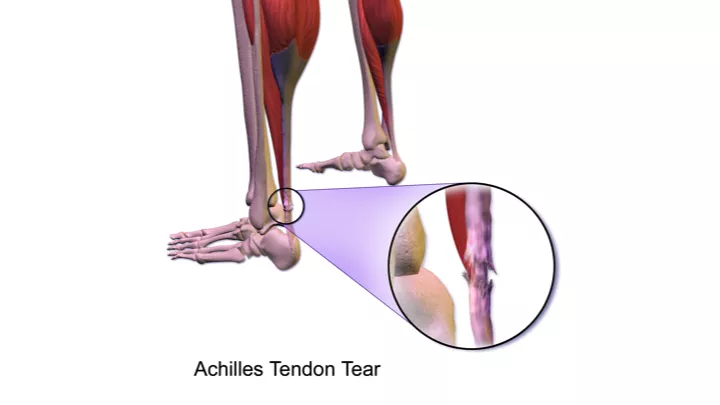 Achilles Tendon Tear - DoveMed