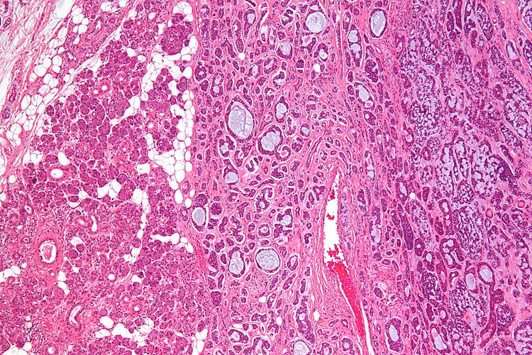 Adenoid Cystic Carcinoma