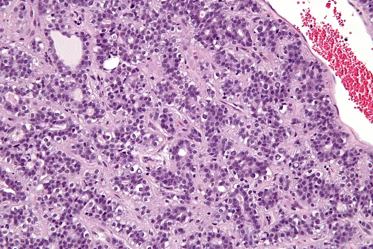 Adenomyoepithelioma Of Breast Dovemed