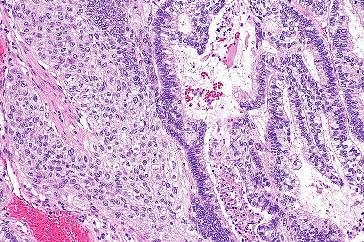 Adenosquamous Carcinoma of Lung