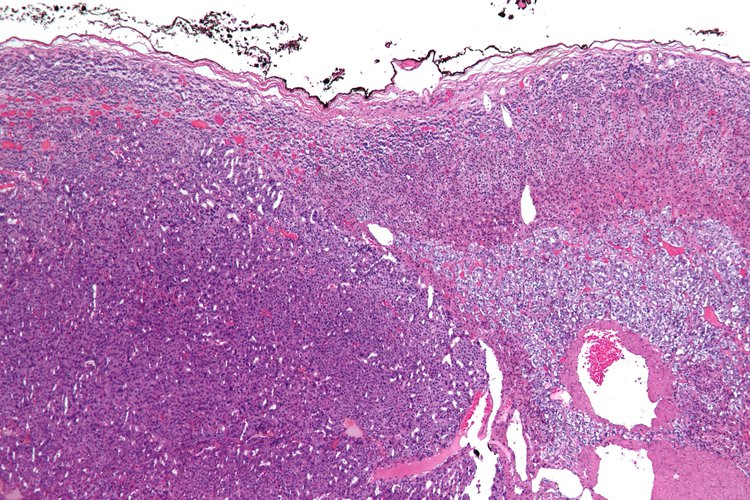 Adrenocortical Carcinoma