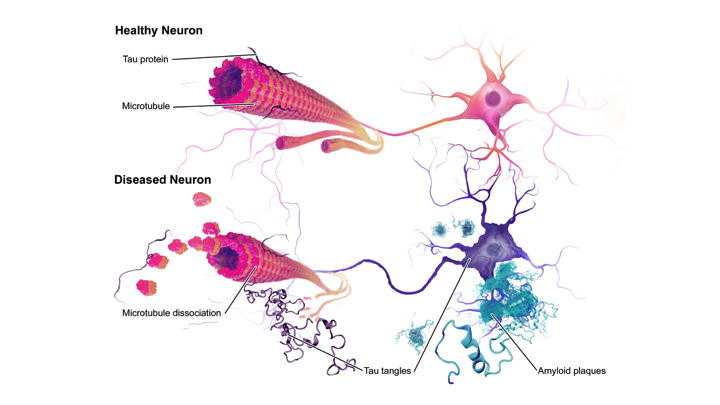 Promising New Target To Combat Alzheimer's Disease