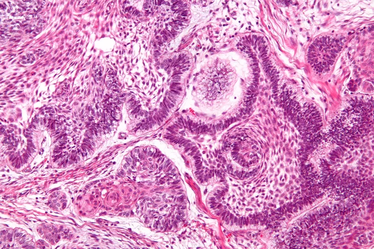 Ameloblastoma - DoveMed