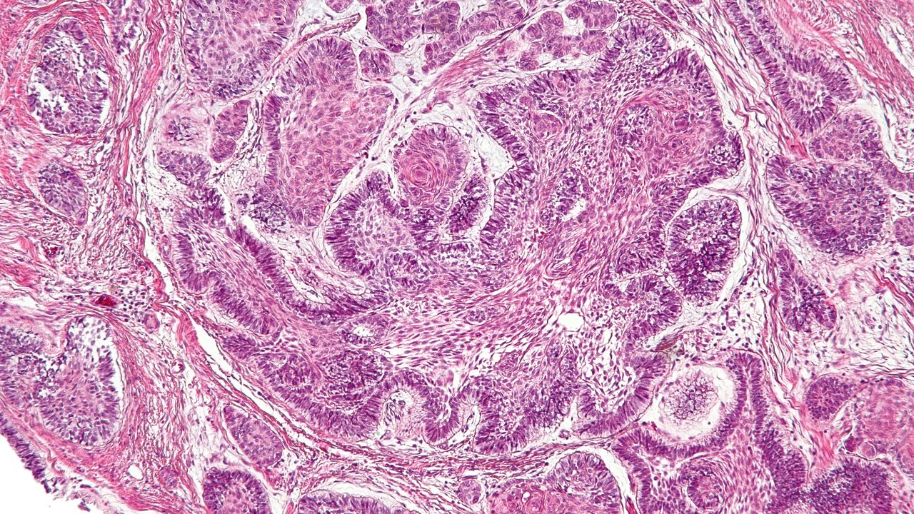 How well do you know Ameloblastoma