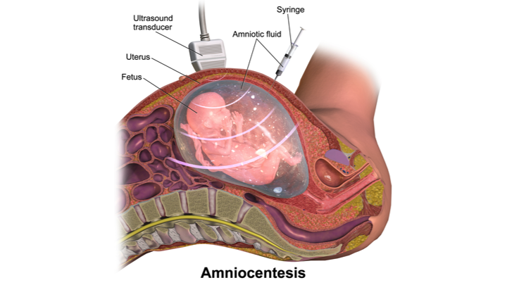 amniocentesis diagram