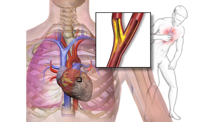 unstable-angina