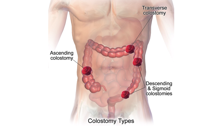 bleeding from colostomy stoma