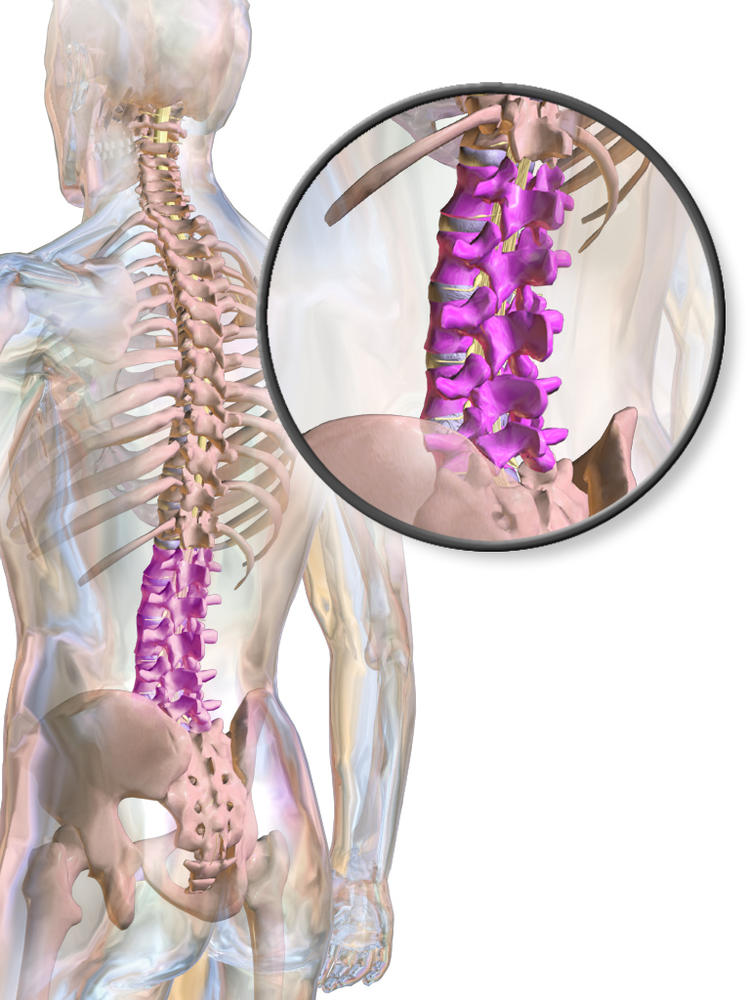 Genetic Clues To Spinal Stenosis