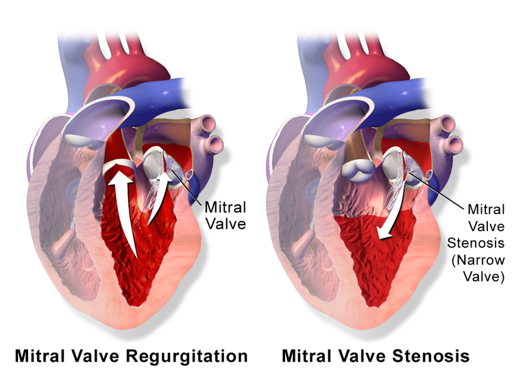 heart-valve-voice-mitral-regurgitation