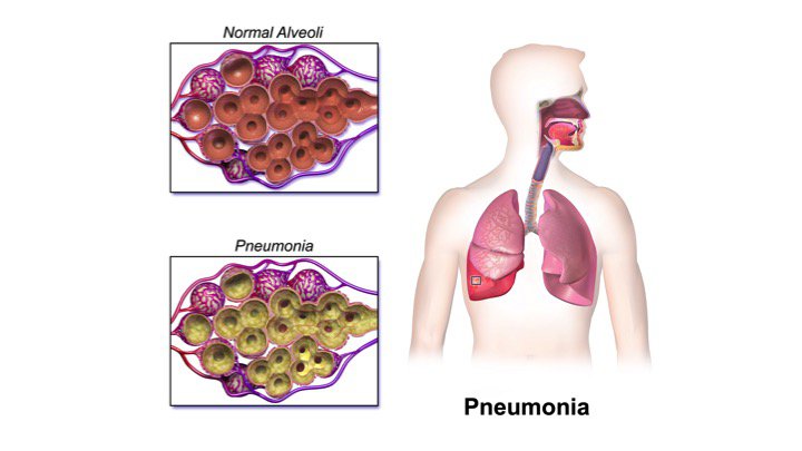 Viral Pneumonia