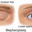 Blepharoplasty-EyeLift.