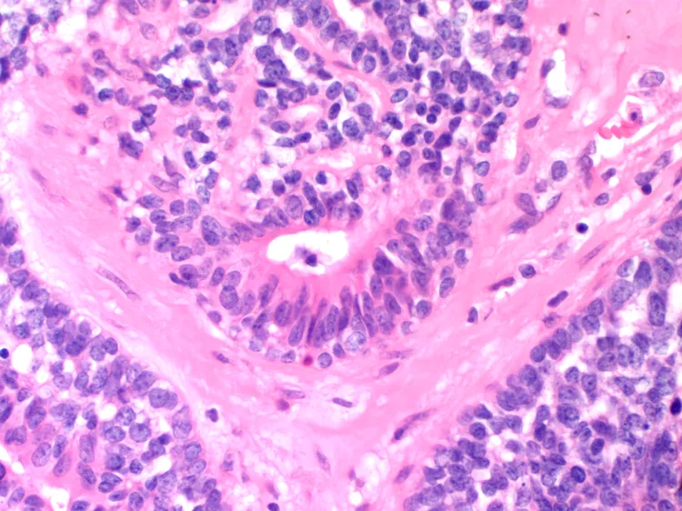 Mixed Type Infiltrating Carcinoma of Breast - DoveMed